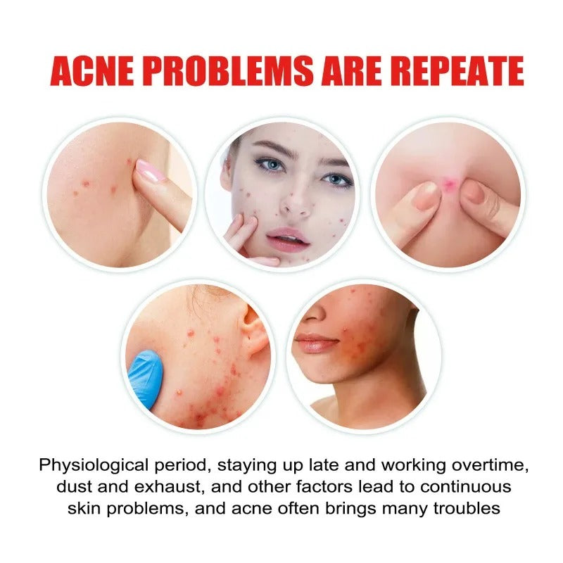 Pimple Stars Hydrocolloid Acne Patches (400 Patches)