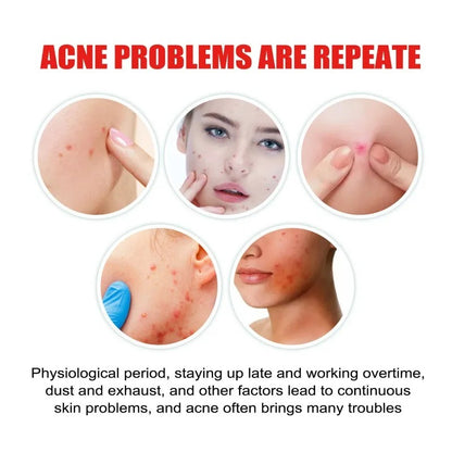 Pimple Stars Hydrocolloid Acne Patches (400 Patches)